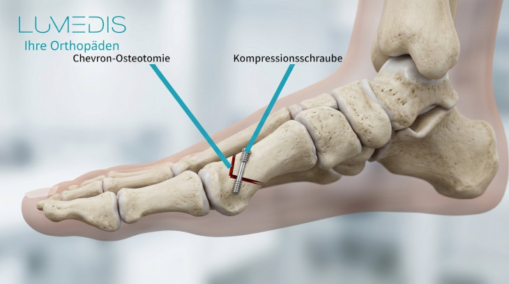 Hallux valgus OP nach Chevron / Austin