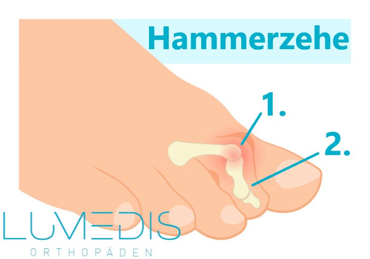 Abbildung einer Hammerzehe