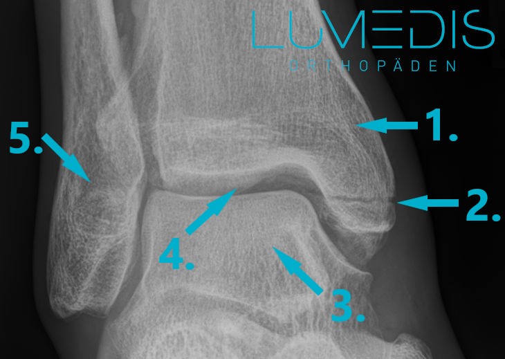 Röntgenbild eines Innenknöchelbruchs