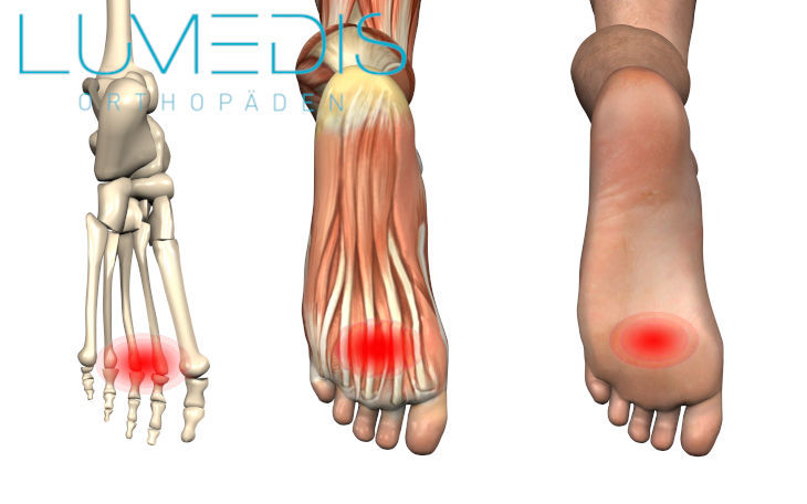 Metatarsalgie - Schmerzen am Fußballen