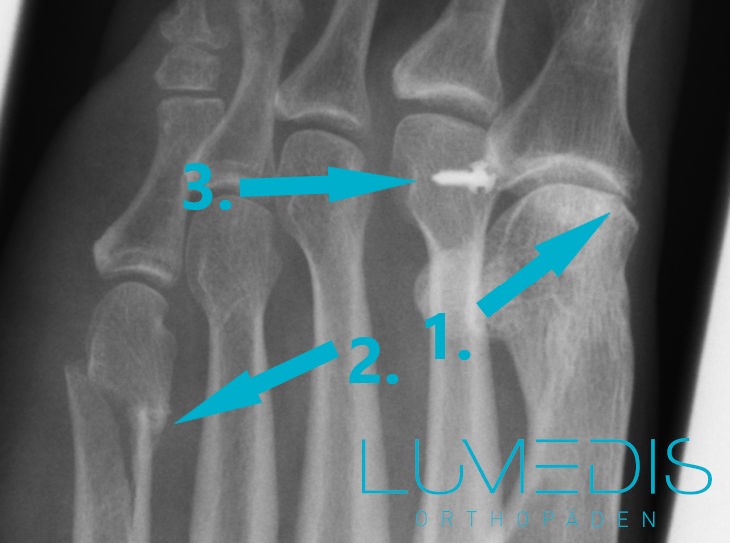 Röntgenbild einer MT V Schaftfraktur