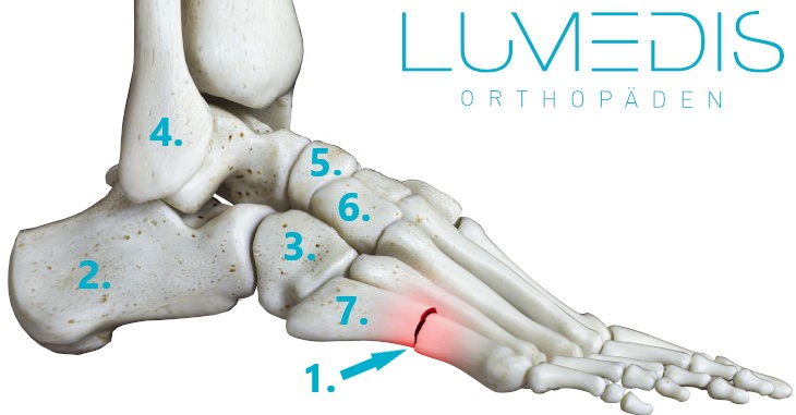 Mittelfuß gebrochen