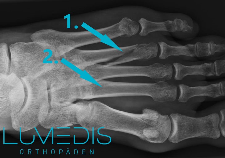 Röntgenbild eines Mittelfußbruchs