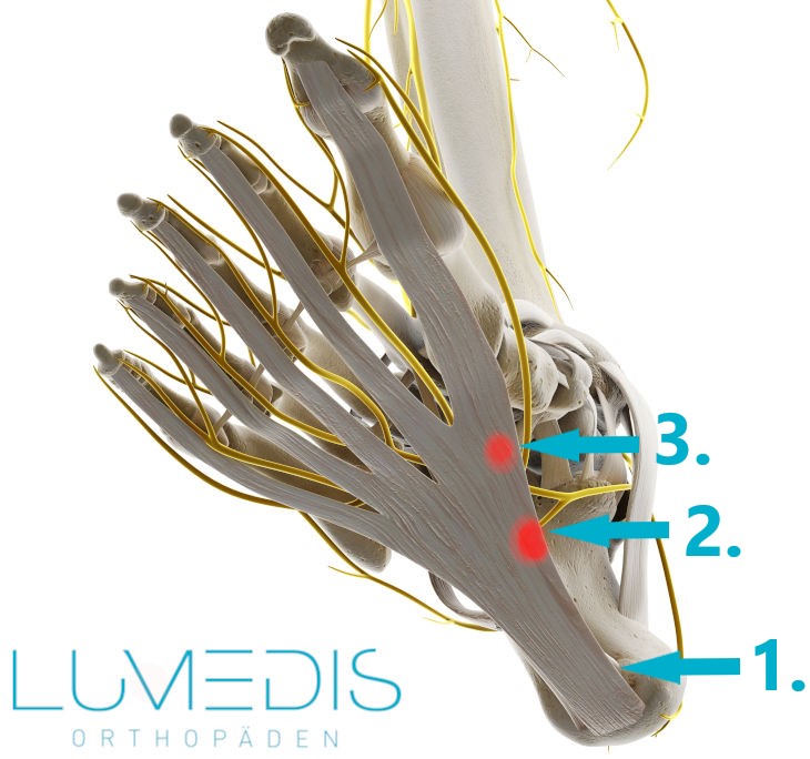 Abbildung eines Morbus Ledderhose in der Plantarfaszie