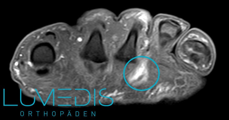 MRT eines Morton Neuroms an typischer Stelle