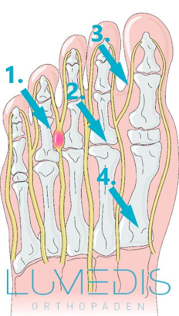 Morton Neurom