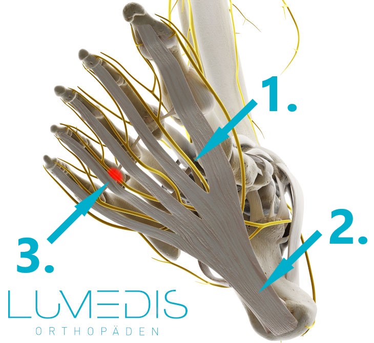 Morton Neurom zwischen dem 3. und 4. Zeh