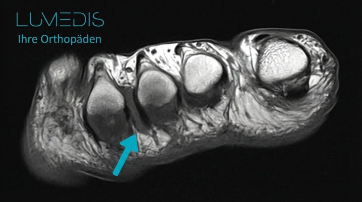MRT (T2) eine Morton Neuroms (türkiser Pfeil)