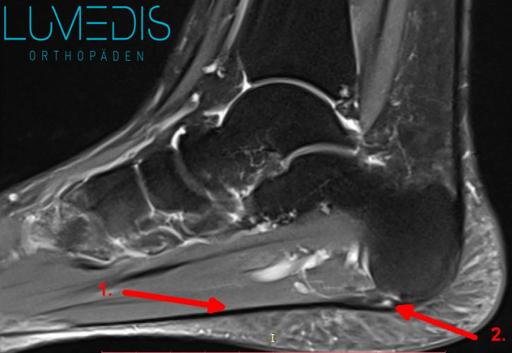 Plantarfasziitis im MRT