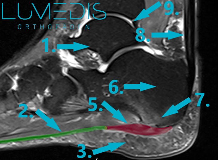 MRT einer Plantarfasziitis