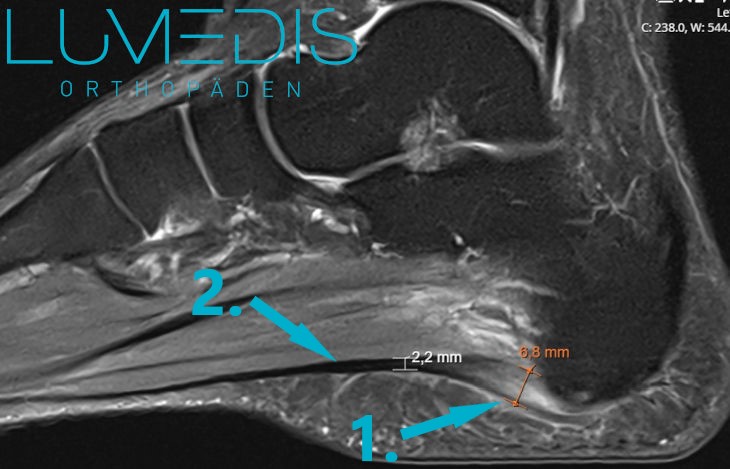 MRT einer schweren Plantarfasziitis