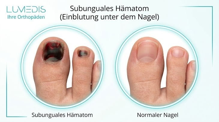 Blut unter dem Nagel vom Zeh