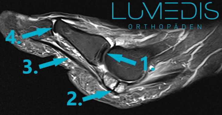Bruch/Fraktur des Sesambeins am Großzeh