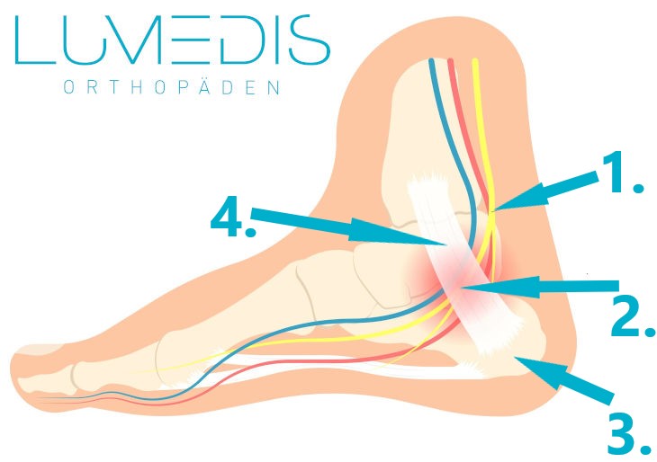 Abbildung eines Tarsaltunnelsyndroms
