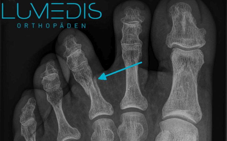 Gebrochen wie gips fuß lange Knochenbruch beim