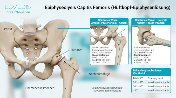 Abbildung einer Epiphyseolysis captitis femoris