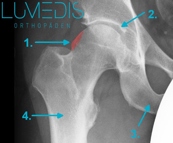 Röntgenbild eines Hüftimpingements (CAM-Impingement)