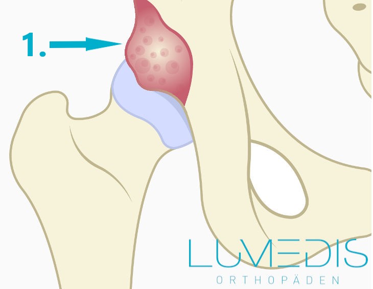 Pincer-Impingement