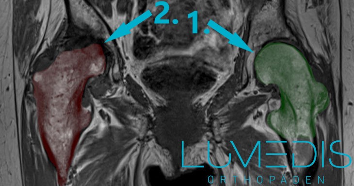 MRT einer Hüftkopfnekrose