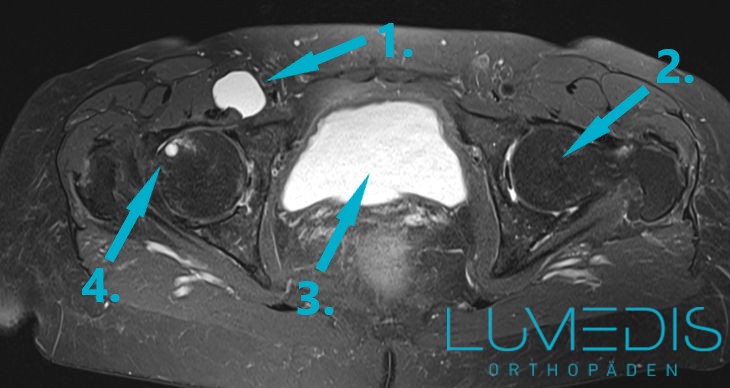 Bursitis iliopectinea Bursitis iliopectinea