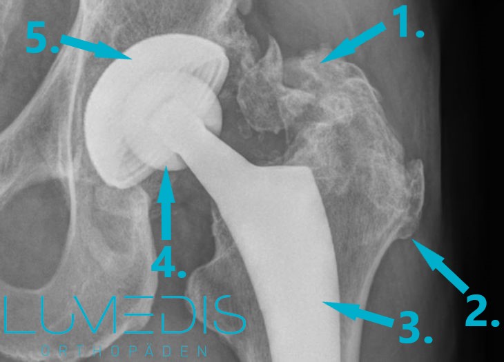 künstliches Hüftgelenk mit heterotoper Verkalkung
