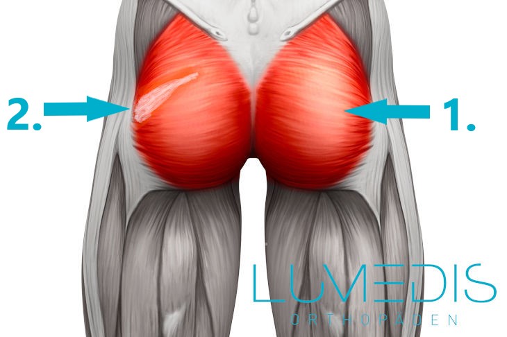 Muskelfaserriss im Gesäß