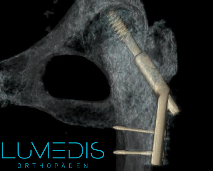 3D Rekonstruktion eines CT Bild einer dynamischen Hüftschraube nach Oberschenkelhalsbruch