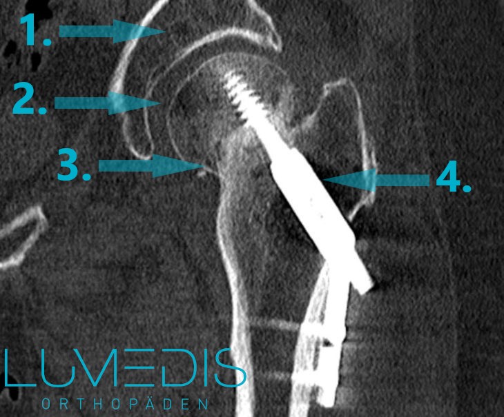 CT Bild einer dynamischen Hüftschraube nach Oberschenkelhalsbruch