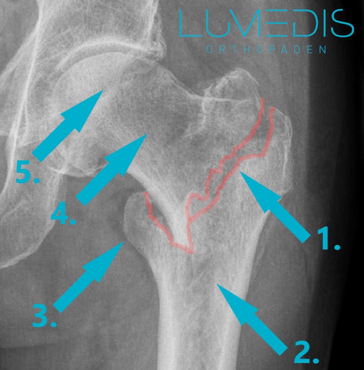 pertrochanterer Hüftbruch Röntgenbild
