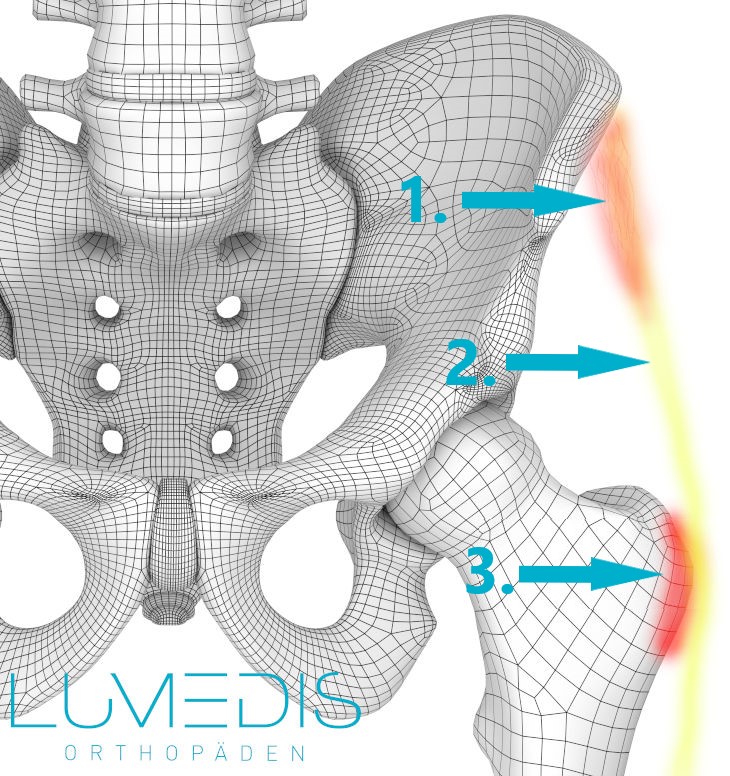 Bursitis trochanterica