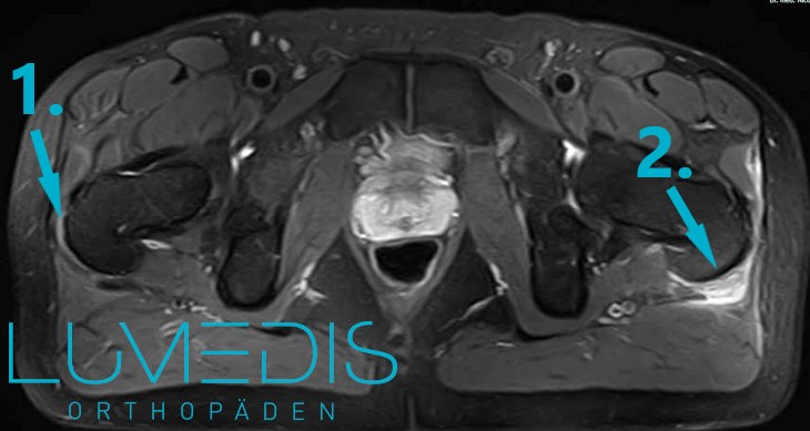 Entzündung der M. gluteus medius Sehne und Schleimbeutelentzündung der Hüfte