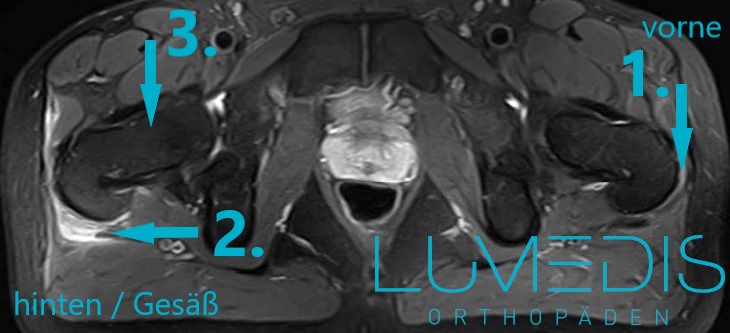 MRT einer Schleimbeutelentzündung der Hüfte