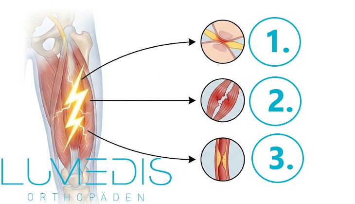 Ursachen für blitzartige Schmerzen im Oberschenkel Ursachen für blitzartige Schmerzen im Oberschenkel