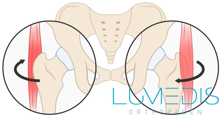 Schnappende Hüfte / Bursitis trochanterica