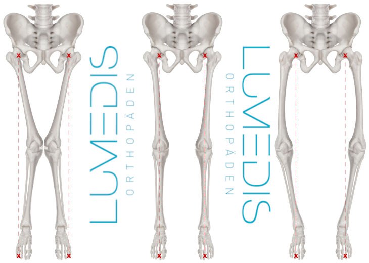 Beinachse / X-Bein / O-Beine