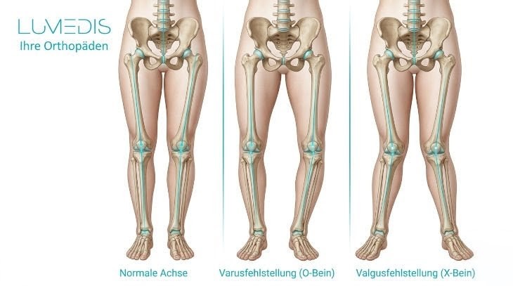 Abbildung einer normalen Beinachse, O-Beine und X-Beine Abbildung einer normalen Beinachse, O-Beine und X-Beine