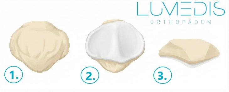 Anatomie der Kniescheibe