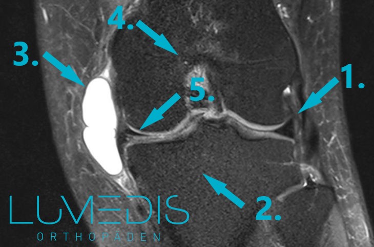 Meniskusganglion (Ganglion am Innenmeniskus)