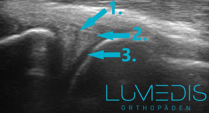 Innenmeniskusriss im Ultraschall