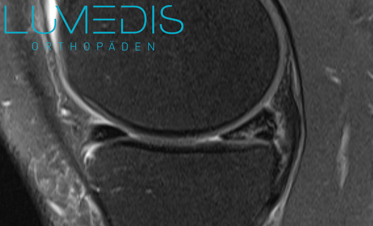 MRT Innenmeniskusriss