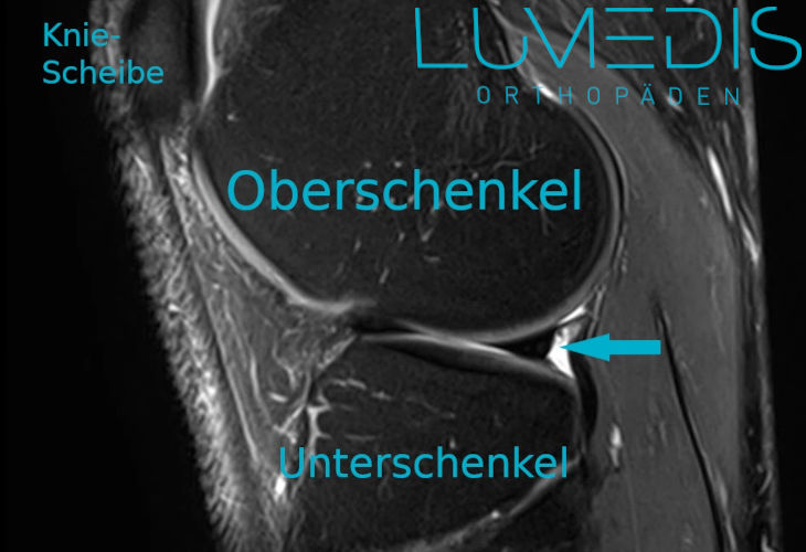 MRT eines gesunden Meniskus
