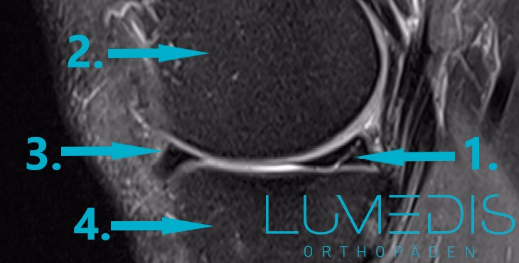 MRT Schrägriss im Innenmeniskushinterhorn MRT Schrägriss im Innenmeniskushinterhorn