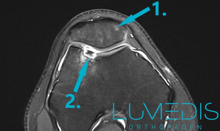MRT: Osteochondrosis dissecans der Trochlea