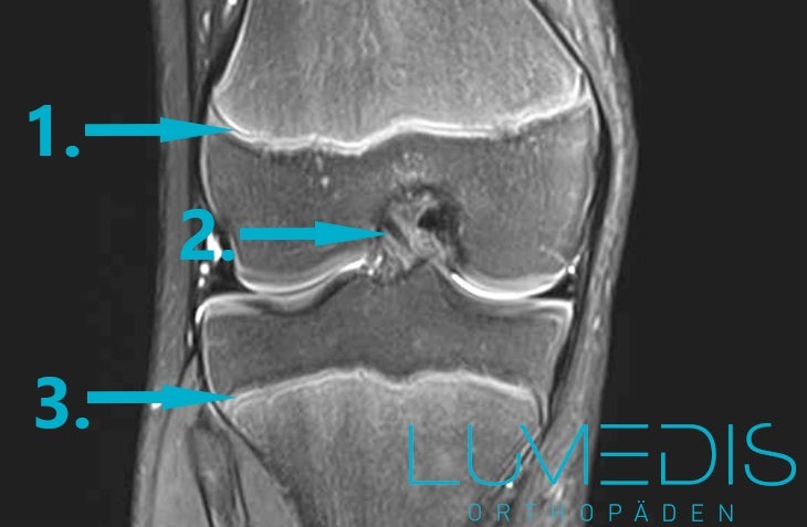 MRT der Wachstumsfugen am Knie beim Kind MRT der Wachstumsfugen am Knie beim Kind