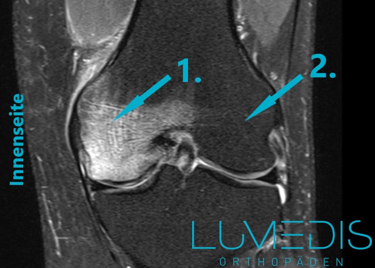 Bone bruise an der medialen Femurkondyle
