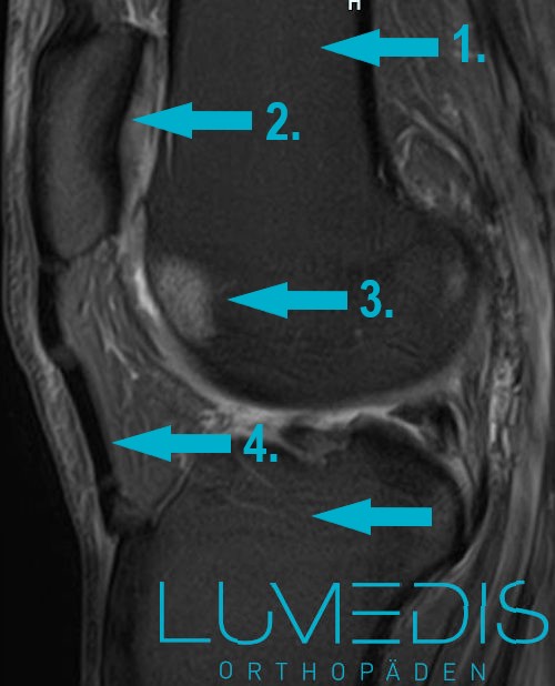 Bone bruise Knie in der Trochlea