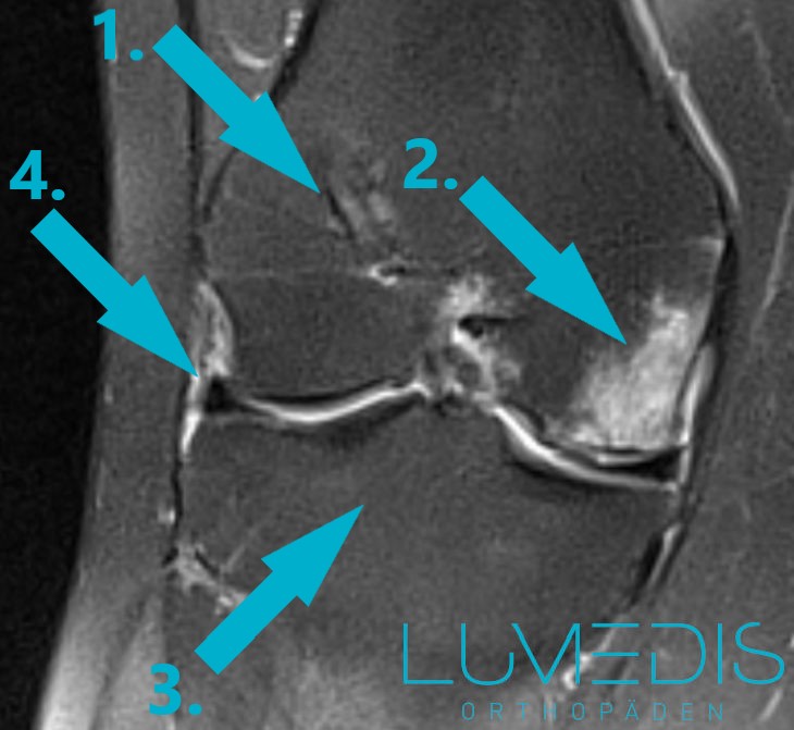 Knochenschwellung Knie