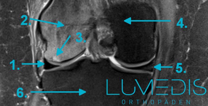 Osteochondrosis dissecans Knie mit OD Femur