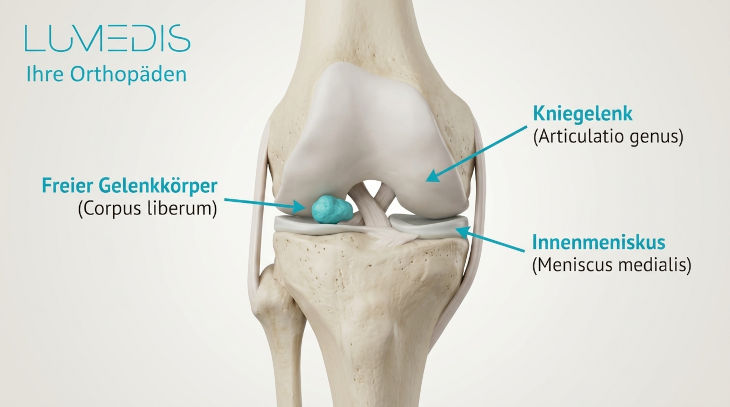 Abbildung eines freien Gelenkkörpers im Knie