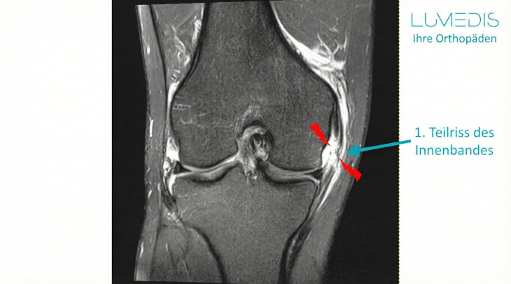 MRT Innenband angerissen